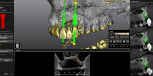 Zahnimplantate Navigation zur sicheren Implantation