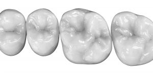Zahnersatz aus Zirkondioxid auf Zahnimplantaten, Zahntechnik